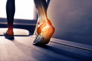 Ankle sprain can be a hindrance in your sports injury treating it with help of sports physiotherapy can aid the fast recovery.