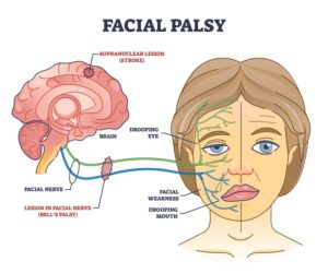 Person undergoing Bell’s Palsy physiotherapy through guided facial exercises to restore muscle symmetry.
