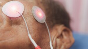 Guided facial exercises in Bell’s Palsy physiotherapy helping restore muscle balance and symmetry.