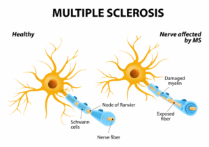 Multiple sclerosis.