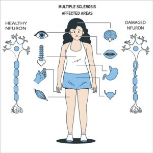 areas affected by multiple sclerosis.