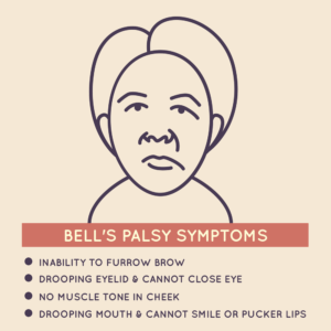 Sudden weakness or paralysis on one side of the face causing drooping and difficulty closing an eye or smiling. Therefor, Bell's Palsy can be treated with Physiotherapy.