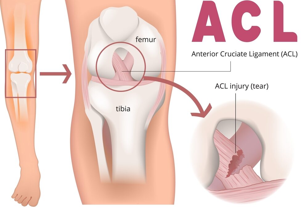 Recovering from ACL Injury: With Physiotherapy