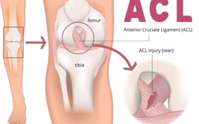 Recovering from ACL Injury: With Physiotherapy