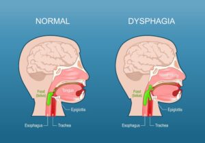 Vital Stim Therapy along with Physiotherapy helps in aiding dysphagia and speech therapy