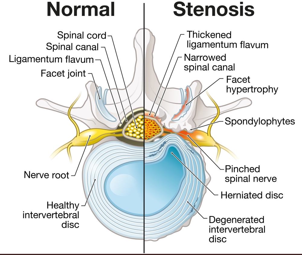 Lumbar Canal Stenosis