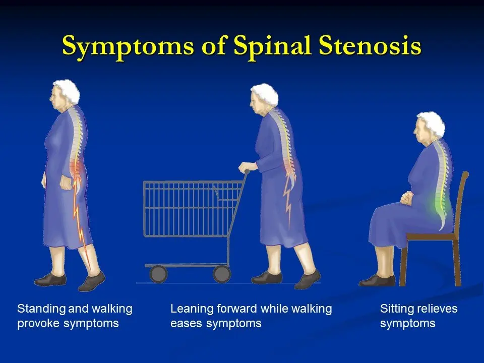 Lumbar Canal Stenosis.