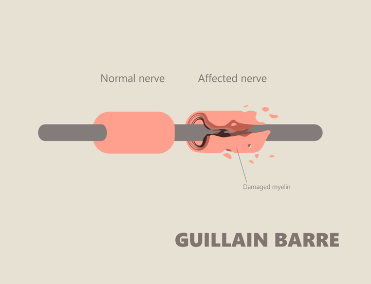 Gullian Bare Syndrome occurs due to nerve issues.
