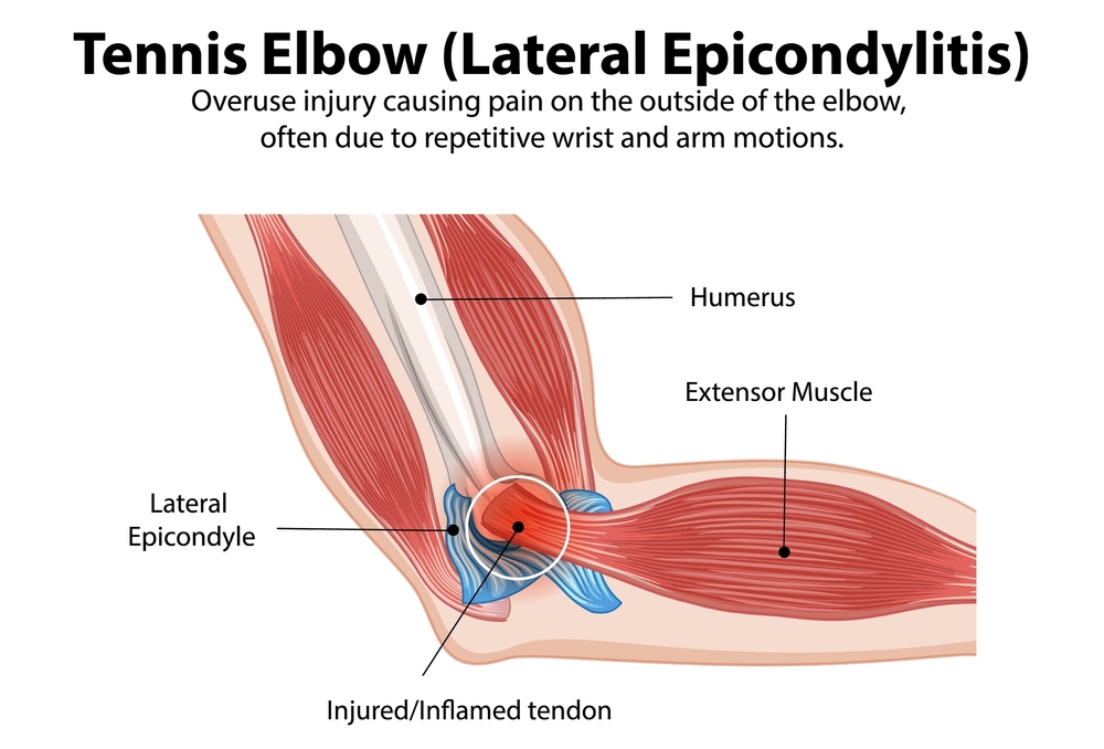 Tennis Elbow Pain