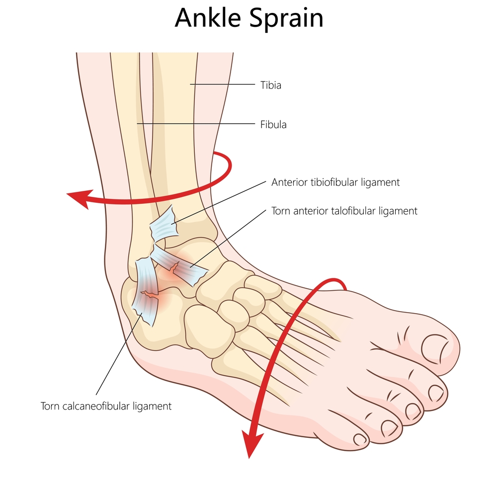 Ankle Sprain