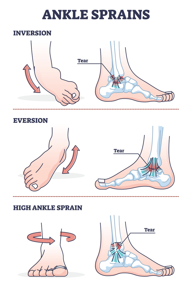 Ankle Sprain