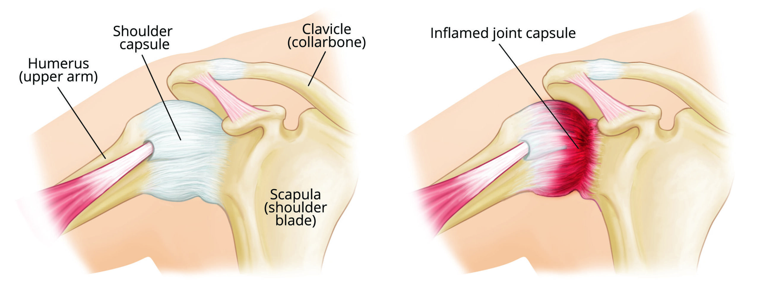 Frozen Shoulder symptoms and reasons.
