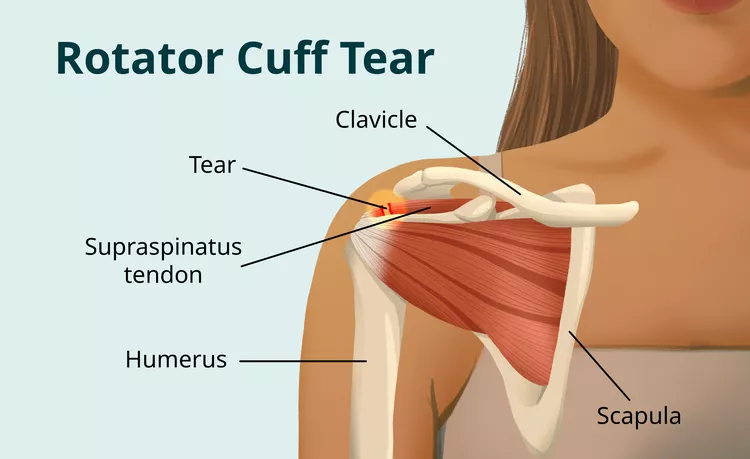 Symptoms of Rotary Cuff Injury.